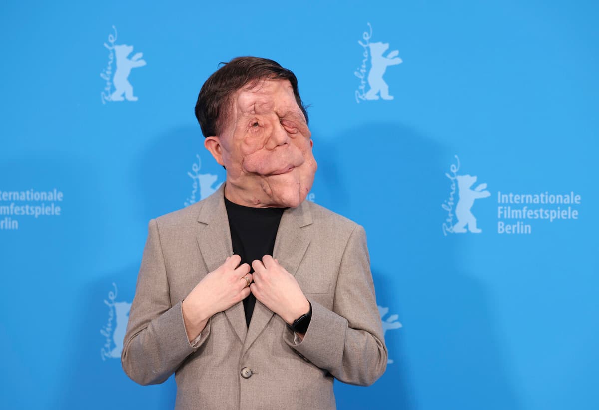 Adam Pearson Cast as First Disabled Actor in The Elephant Man