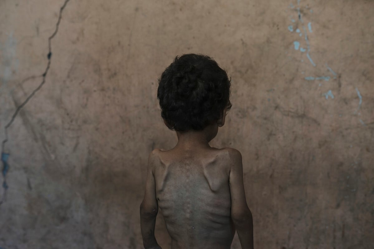 Gaza Crisis: UN Urges More Aid as Children Face Severe Malnutrition