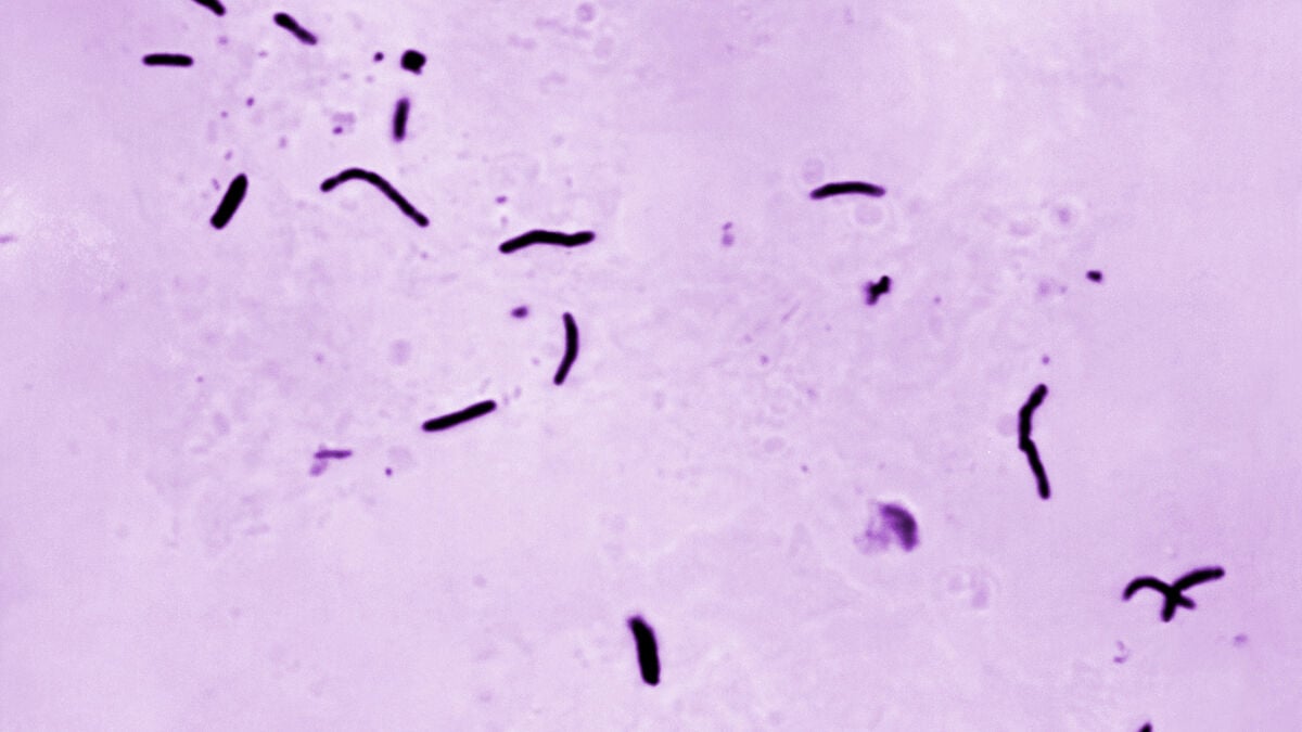 Algorithms detect tuberculosis in children