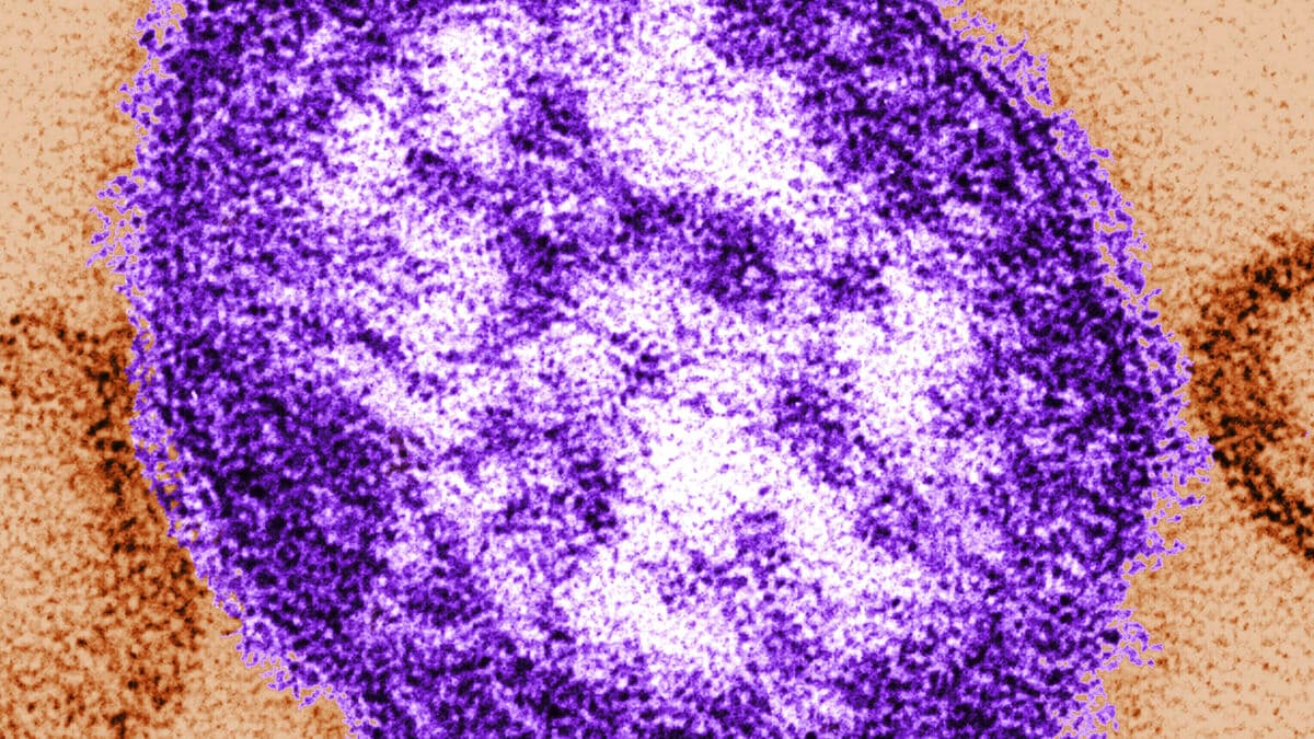 Measles cases rise to 11 in Urkult outbreak, contact tracing under way