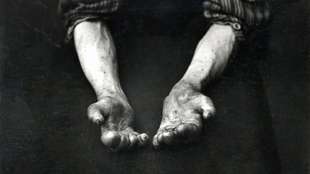 Leprosy case in Romania – first in 40 years