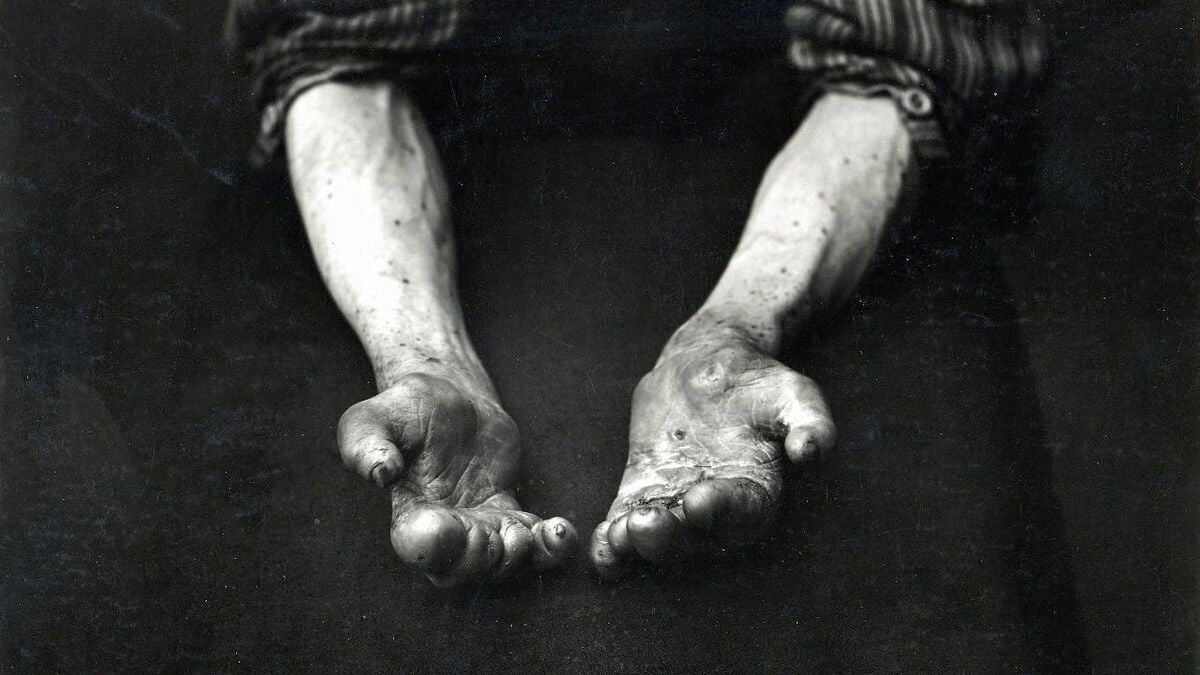 Leprosy case in Romania – first in 40 years