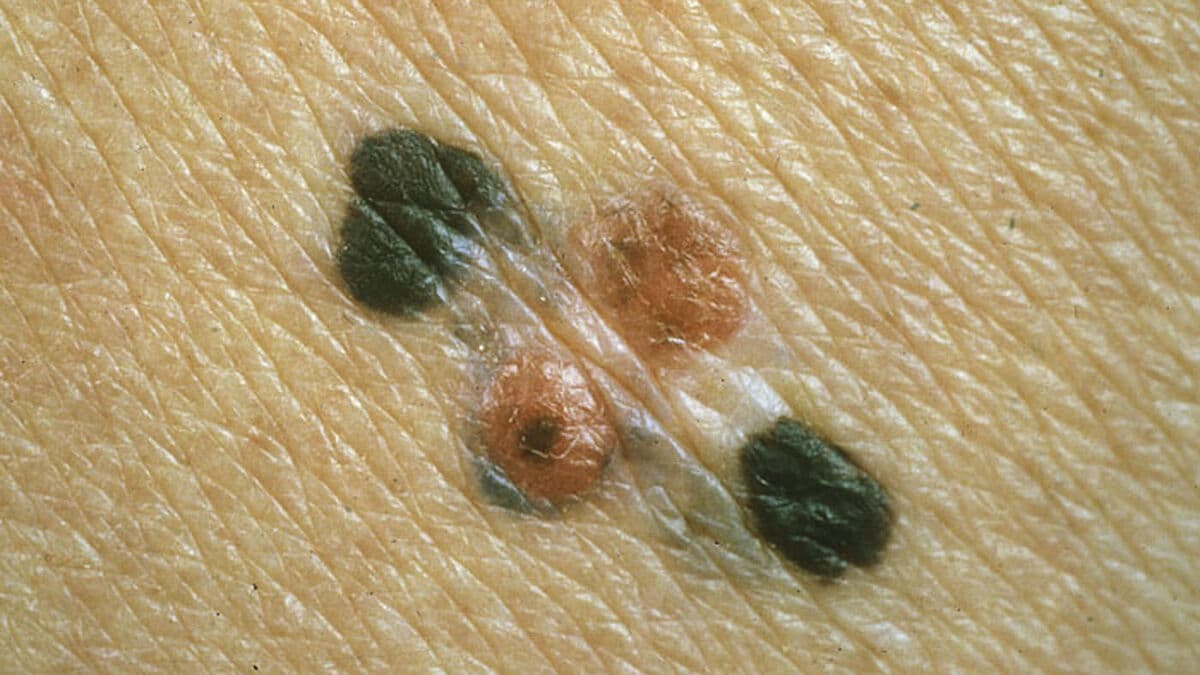 Moderna shares soar after study shows cancer vaccine slows melanoma recurrence