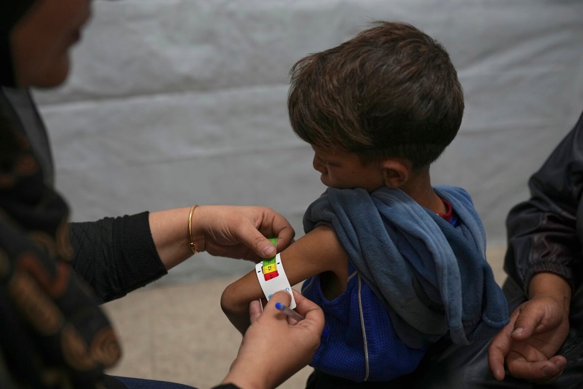 UN Warns of Rising Acute Malnutrition in Gaza's Children