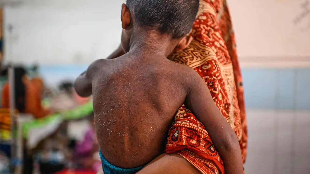 Bangladesh measles outbreak kills more than 1,000 children