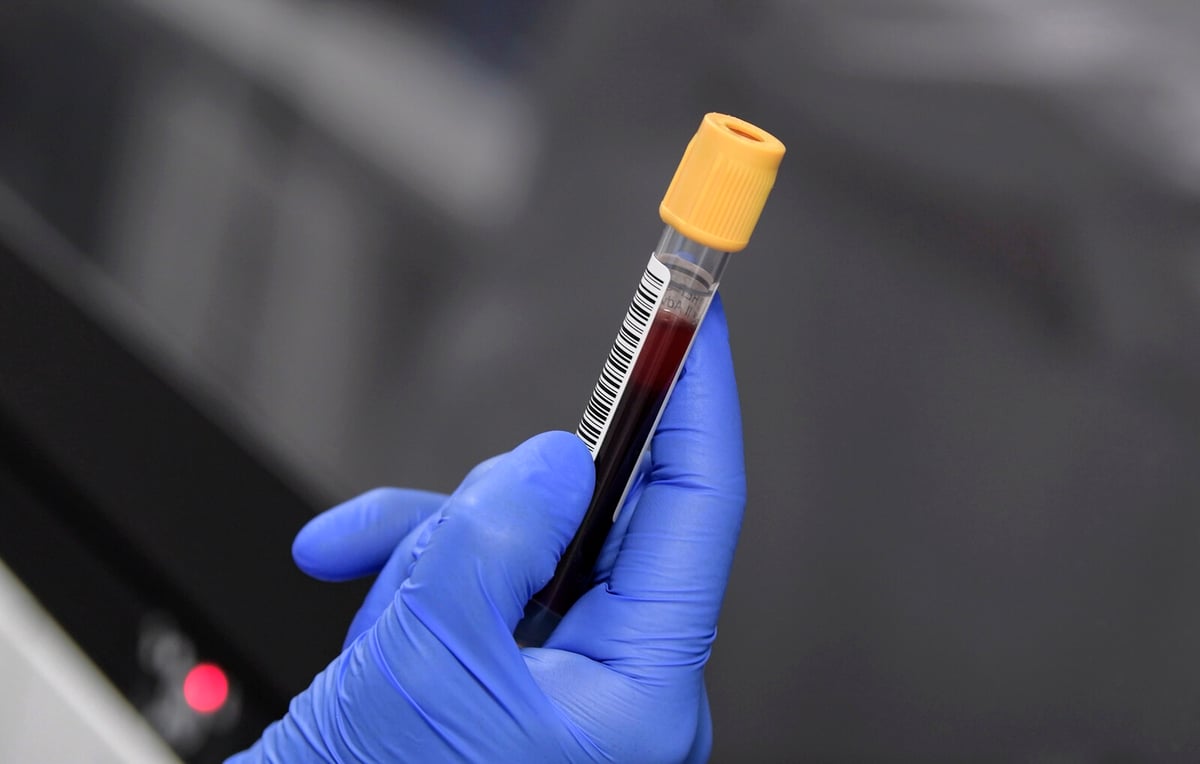 New Blood Marker Tracks Alzheimer's Progression, Aiding Drug Approval