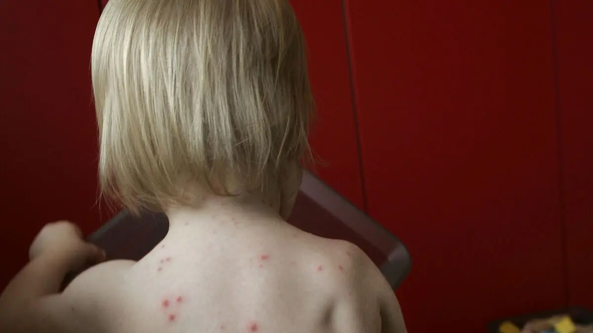 Free chickenpox vaccine for children to be added to Sweden’s vaccination programme