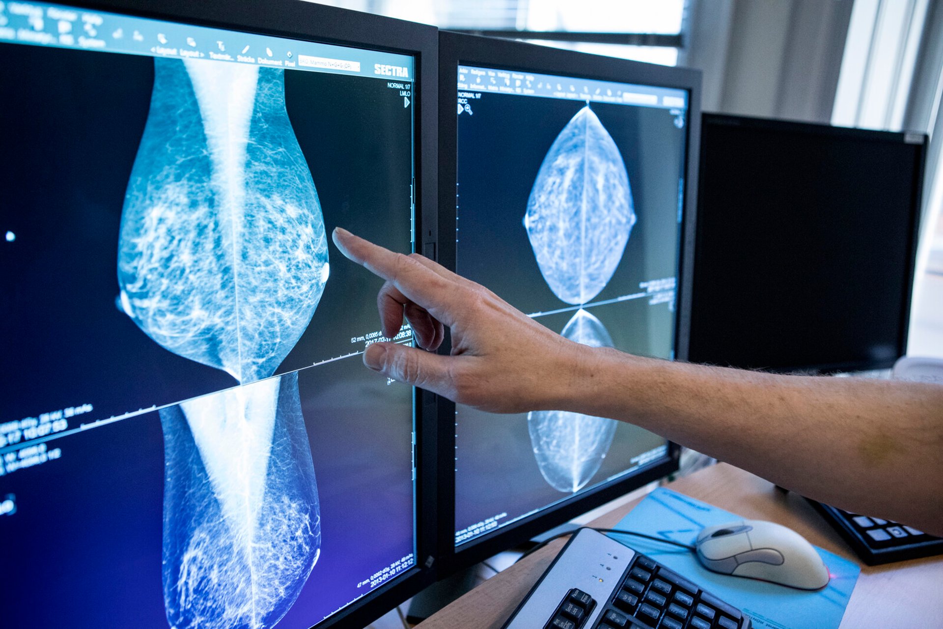 Success when AI detects breast cancer