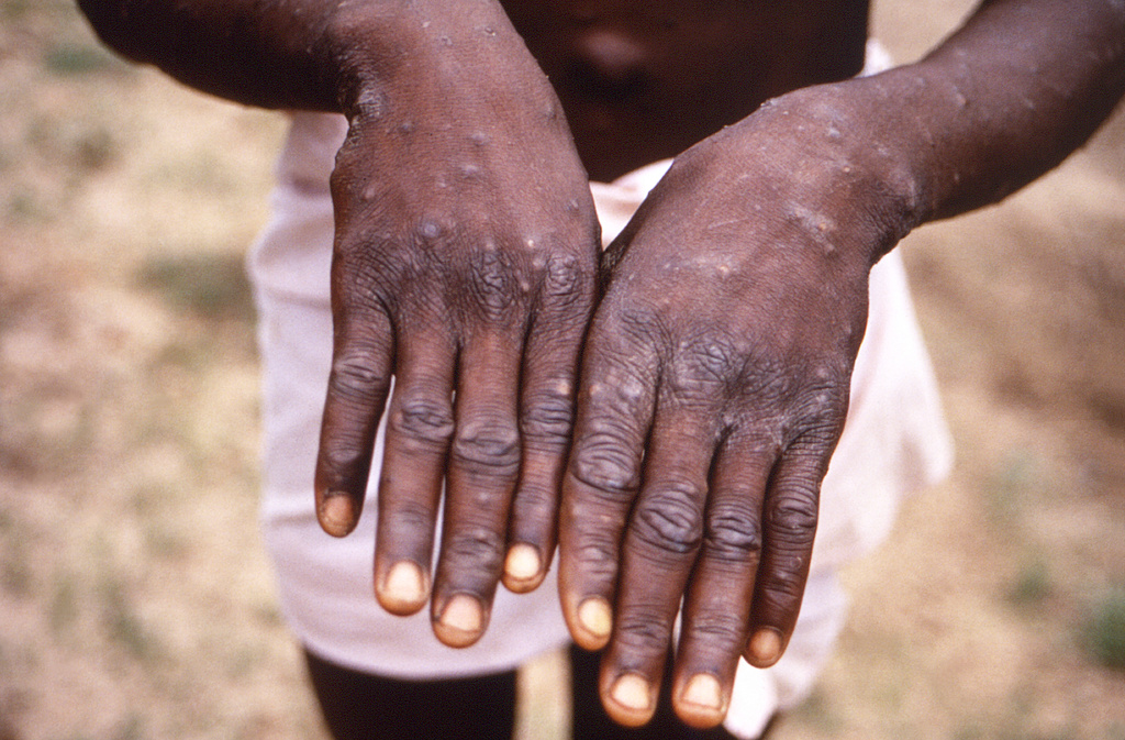 Health Emergency Declared After Outbreak of Mpox