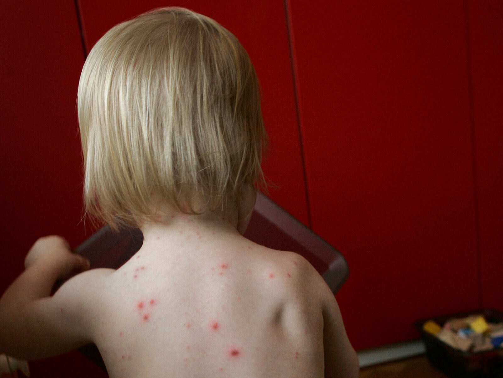 Proposal: All Children Should Receive Chickenpox Vaccination