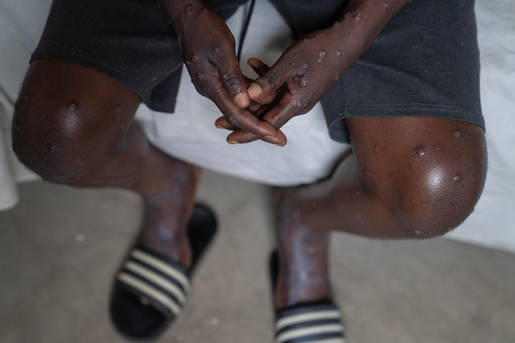 Save the Children sound the alarm: Mpox worst for young people