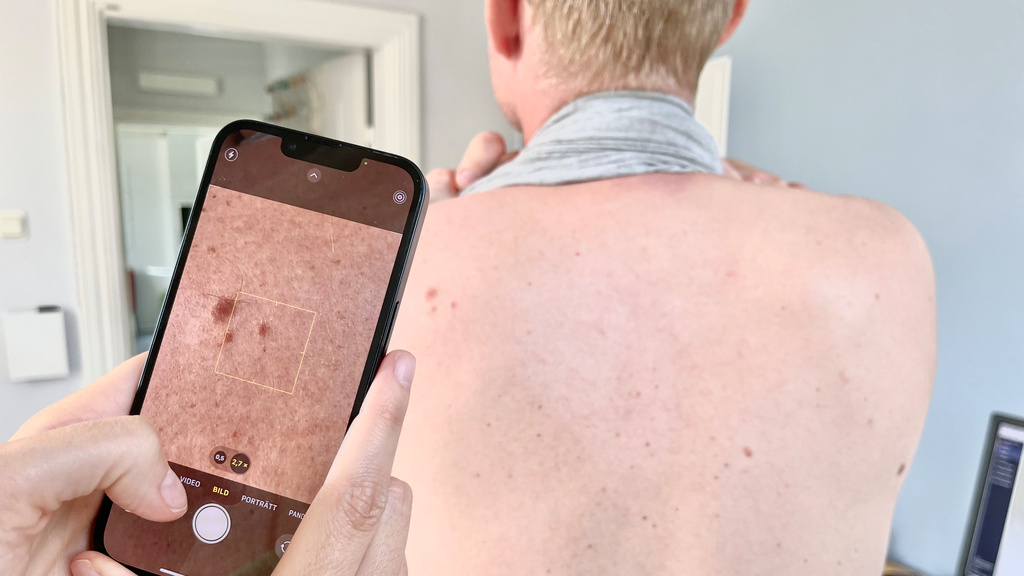 Doctors: Don't trust skin cancer apps